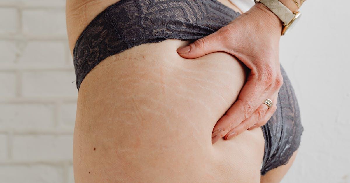 Brzuch jak nowy: jak mezoterapia kwasowa wygładza rozstępy i przywraca pewność siebie