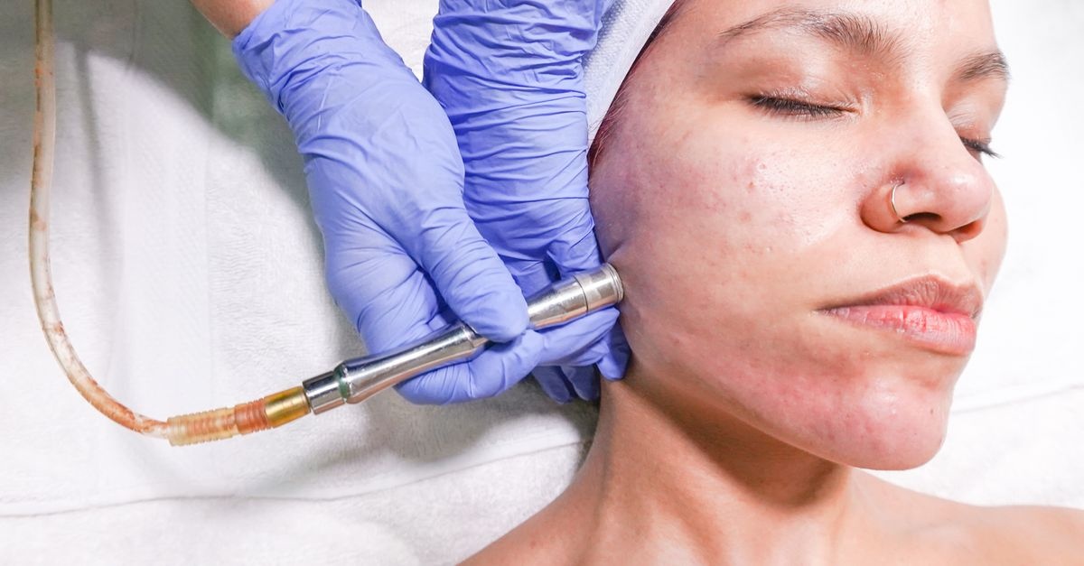 Dermabrazja mechaniczna: ile trwa gojenie i jak przyspieszyć powrót gładkiej skóry?