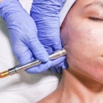 Dermabrazja mechaniczna: ile trwa gojenie i jak przyspieszyć powrót gładkiej skóry?